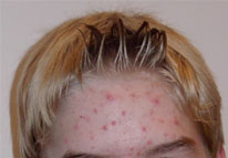 treating�acne | top�acne�treatments