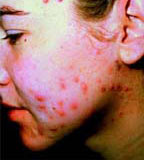 treating�acne | top�acne�treatments